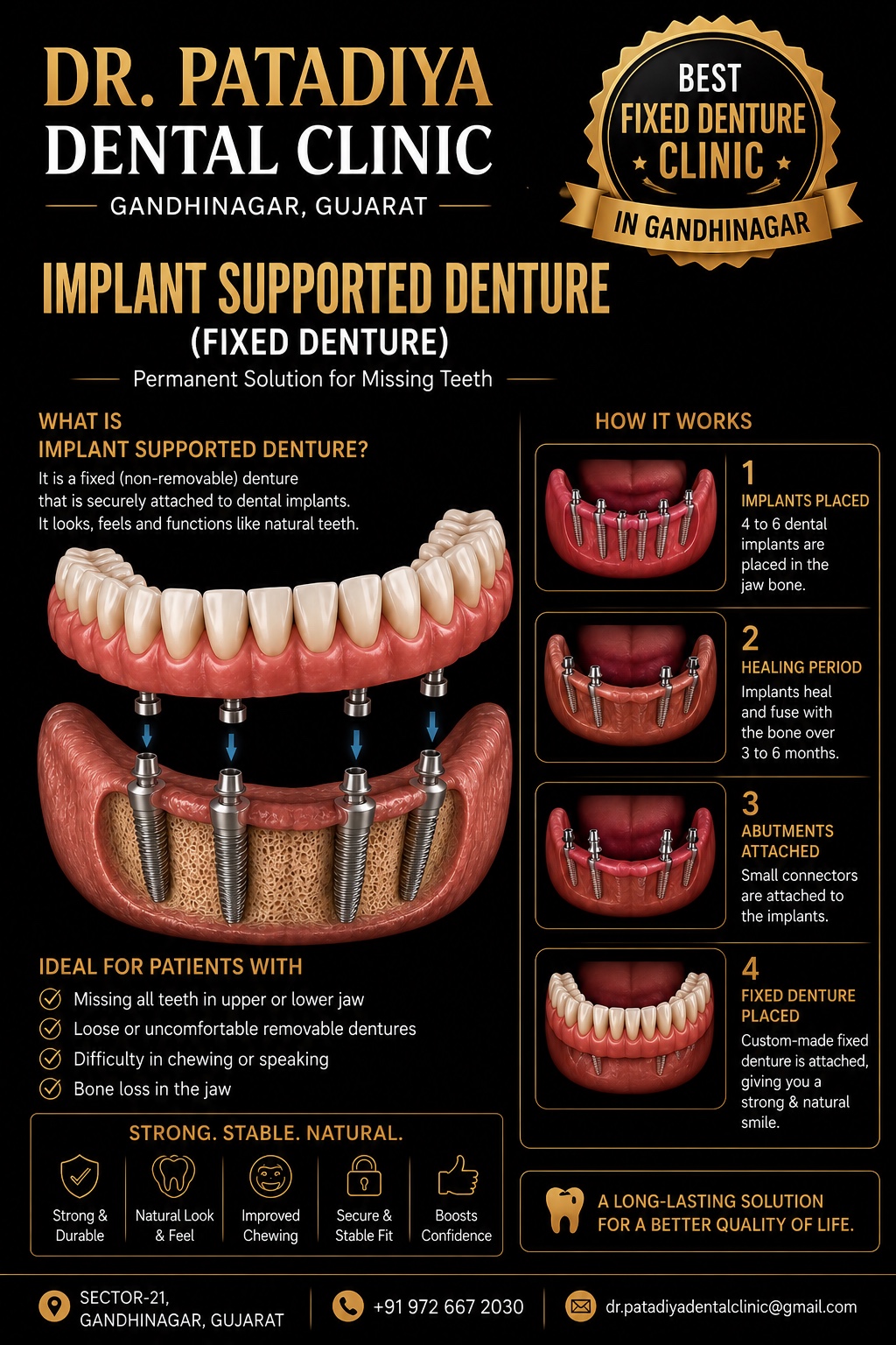 Implant Supported Denture Fixed Denture educational poster – Dr. Patadiya Dental Clinic Gandhinagar