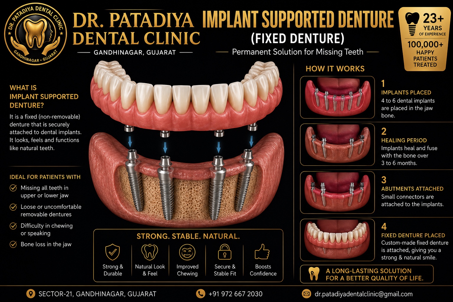 Implant Supported Fixed Denture – Dr. Patadiya Dental Clinic Gandhinagar
