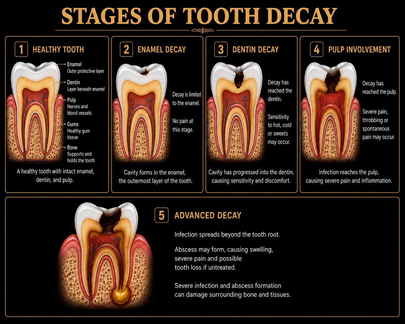 Stages of tooth decay from healthy tooth through advanced decay and abscess