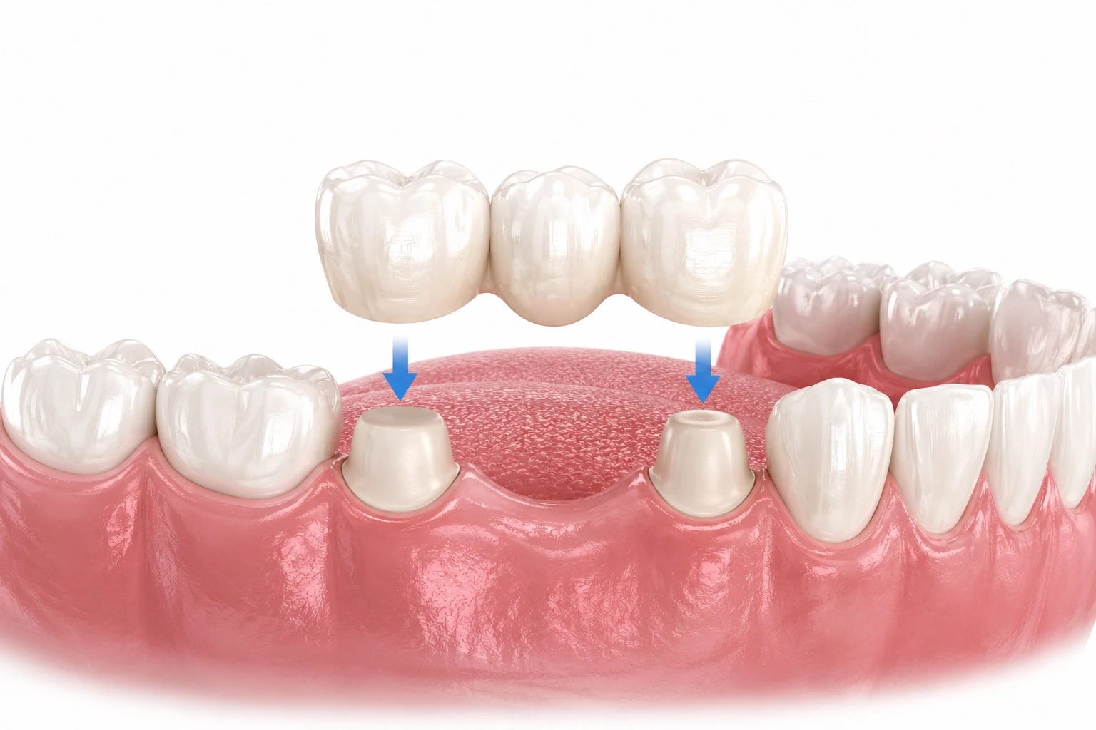 Dental crown materials comparison including zirconia and ceramic restorations